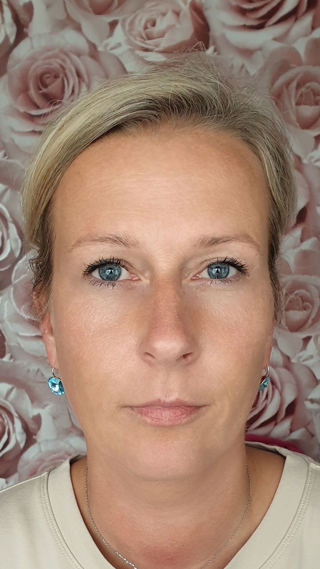 before lip transformation lady 01